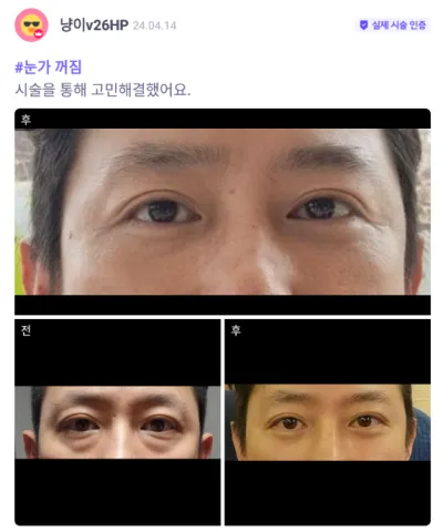 [Babytalk] Нүдний доод өөх шилжүүлэн байрлуулах / 2 сар болж байна / Никнейм: Нян-иv26HP