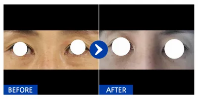 [Gangnam Unni] Нүдний доод өөх шилжүүлэх / 1 сар болж байна / Никнейм: Ча Дү-ри гуя