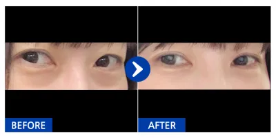 [Gangnam Unni] Нүдний доод өөх шилжүүлэх / 1 сар болж байна / Никнейм: Мүнтэн