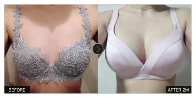 [Gangnam Unni сэтгэгдэл] Хөхний хагалгаа 2 сар болж байна / Ник нэр: 비띵