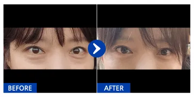 [Gangnam Unni] Нүдний доод өөх шилжүүлэн байрлуулах / 1 сар болж байна / Никнейм: Айс Пиа