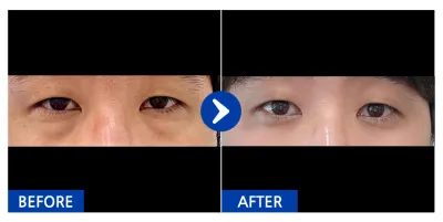 [Gangnam Unni] Нүдний доод өөх шилжүүлэн байрлуулах / 1 сар болж байна / Никнейм: Пэнбэри