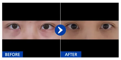 [Gangnam Unni] Нүдний доод өөх шилжүүлэн байрлуулах / 1 сар болж байна / Никнейм: Япши