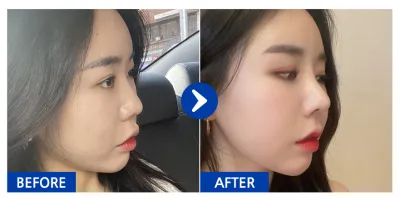 [Gangnam Unni] Хамрын хагалгаа / 1 сар болж байна / Никнейм: Дырырырык дырырык