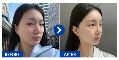 [Gangnam Unni] Хамрын хагалгаа, Нүүрний хэлбэр засах 2 төрөл (Шанаа, Дөрвөлжин эрүү) / 1 сар болж байна / Никнейм: Коаллио