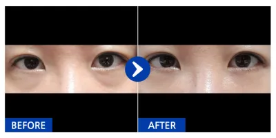 [Gangnam Unni] Нүдний доод өөх шилжүүлэн байрлуулах / 1 сар болж байна / Никнейм: Наэёны