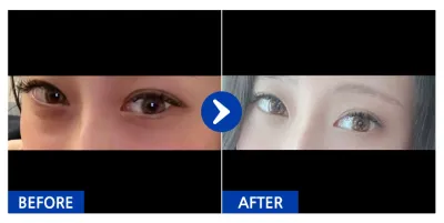 [Gangnam Unni] Нүдний доод өөх шилжүүлэн байрлуулах / 1 сар болж байна / Никнейм: Мондүн-и эгч