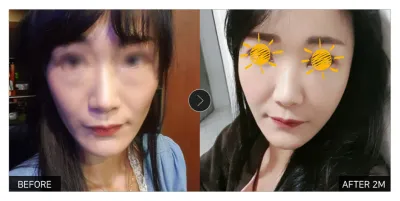 [Gangnam Unni сэтгэгдэл] Нүүрний бүх хэсэгт өөх шилжүүлэн суулгах + Нүдний доорх өөх дахин хуваарилах 2 сар болж байна / Ник нэр: 라비네