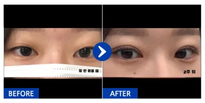 [Gangnam Unni] Байгалийн наалдац (давхраа) / 1 сар болж байна / Никнейм: easyn