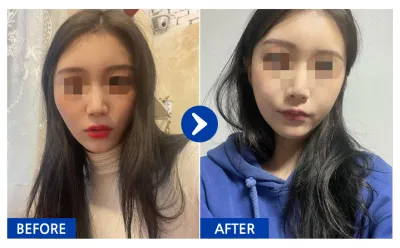 [Babytalk] Нүүрний хэлбэр засах / 1 сар болж байна / Никнейм: Борыыыымдал