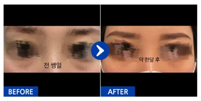 [Gangnam Unni] Нүдний доод өөх шилжүүлэн байрлуулах / 1 сар болж байна / Никнейм: Шёрон