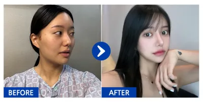 [Babytalk] Нүүрний хэлбэр засах 3 төрөл, Хамрын хагалгаа / 6 сар болж байна / Никнейм: Пак Тэн-тэн