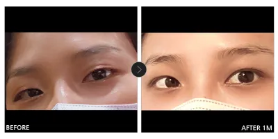 [Gangnam Unni сэтгэгдэл] Нүдний хагалгаа 1 сар болж байна / Ник нэр: 피곤한아르마딜로