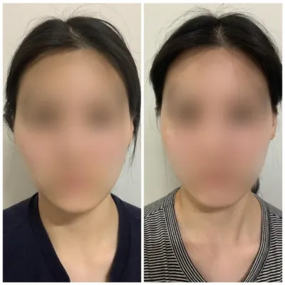 [Gangnam Unni сэтгэгдэл] Нүүрний хэлбэр засах хагалгаа 1 сар болж байна / Ник нэр: 도비메라