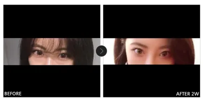 [Babytalk сэтгэгдэл] Нүдний доорх өөх дахин хуваарилах 2 долоо хоног болж байна / Ник нэр: 매이라