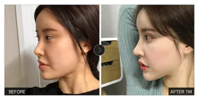 [Gangnam Unni сэтгэгдэл] Хамрын хагалгаа хийлгээд нэг сар / Хоч: