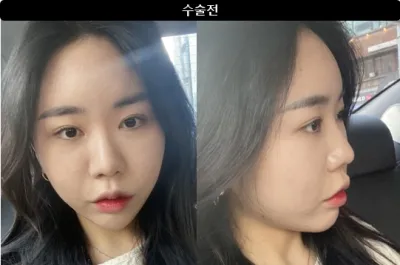 [Gangnam Unni сэтгэгдэл] Хамрын хагалгаа 1 сар болж байна / Ник нэр: 드르르륵드르륵