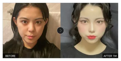 [Gangnam Unni сэтгэгдэл] Нүүрний өөх шилжүүлэн суулгаад 1 сар болж байна / Никнейм: 담공마인두