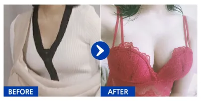 [Gangnam Unni] Хөхний мэс засал / 2 сар болж байна / Никнейм: 치즈마니