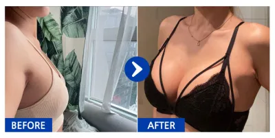 [Gangnam Unni] Хөхний мэс засал (Motiva) / 5 сар болж байна / Никнейм: Regina0