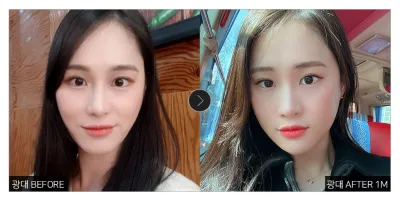 [Gangnam Unni сэтгэгдэл] Хацрын яс багасгах мэс засал хийлгээд 1 сар болж байна / Никнейм: 희니마니무