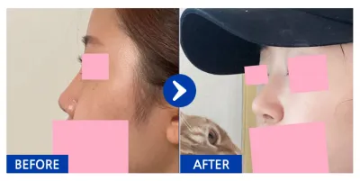 [Gangnam Unni] Хамрын мэс засал / 2 сар болж байна / Никнейм: 젤리리리릴