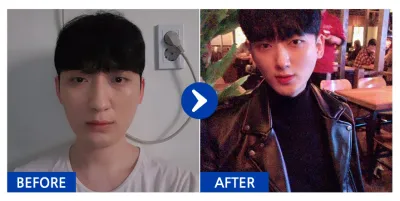 [Gangnam Unni] Хамрын мэс засал / 4 дэх сар / Никнэйм: 핵규