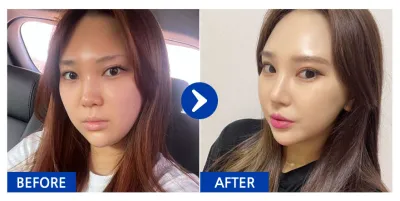 [Gangnam Unni] Хамрын мэс засал / 5 дахь сар / Ник нэр: 검은진주