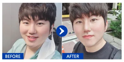 [Gangnam Unni] Хамрын мэс засал / 5 дахь сар / Ник нэр: 본주로남