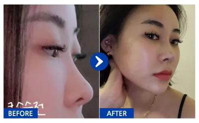 [Babytalk] Хамрын мэс засал / 2 дахь сар / Ник нэр: 꽃슈니이