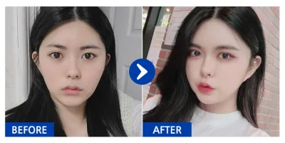 [Бабиток] Өөх шилжүүлэн суулгах, Нүүрний хэлбэр засах, Давхраа / 3 дахь сар / Ник нэр: 우아어아아아