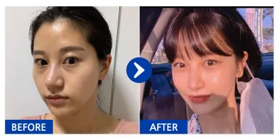 [Бабиток] Өөх шилжүүлэн суулгах / 5 дахь сар / Ник нэр: 아멜리칼노