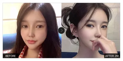 [Gangnam Unni сэтгэгдэл] Нүдний хэлбэр засах, нүдний дахин мэс засал хийлгээд 1 сар болж байна / Никнейм: wingit