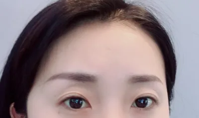 [Нүд] Ким Жон Ким Жом - Арьс сунгах, Доод зовхины сунгалт