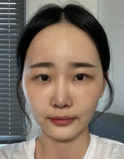 [Нүд] Жижиг - Давхар зовхины оёдол, урд зүсэлт, доод зүсэлт