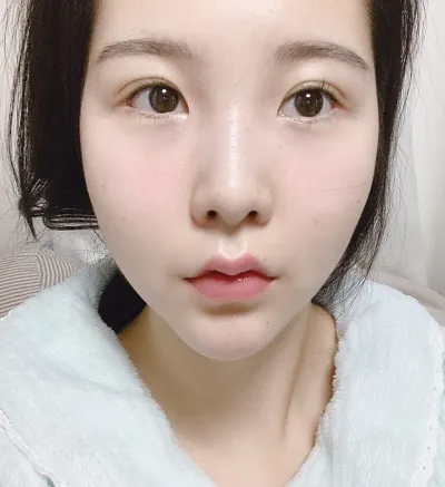 [Нүд] Өвөл - Зүсэлттэй давхар зовхи (давтан хагалгаа), урд зовхины өргөтгөл (давтан хагалгаа), доод зовхины өргөтгөл