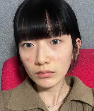 [Нүд] Ислийн арга - Зүсэлгүй зовхины хэлбэр засах