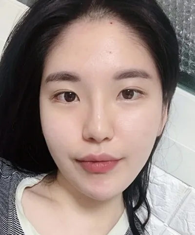 [Нүд] Гүзээлзгэнэ - Урд зовхины мэс засал