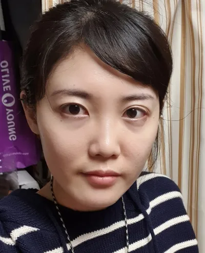 [Нүд] Эерэг - Зүсэлттэй давхар зовхины дахин хагалгаа