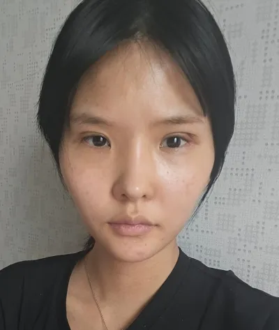 [Нүд] Минчодан - Зүсэлттэй нүдний хэлбэр засах, урд зовхины өргөтгөл, хойд зовхины өргөтгөл, доод зовхины өргөтгөл дахин мэс засал