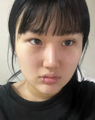 [Нүд] Саарал Банана - Зүсэлттэй давхар зовхины дахин хагалгаа, урд зүсэлт