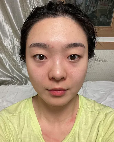 [Нүд] Панда - Нүдний доод өөхөн эдийг дахин байршуулах