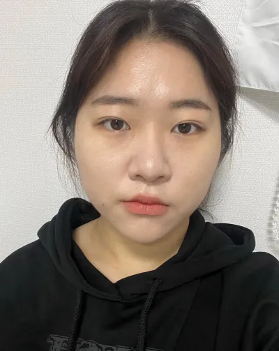 [Нүд] Чэрийн Желe - Ар, Доод зовхины тайралт