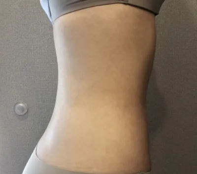 [Өөх соруулах] Од шиг нисээрэй - Хэвлий, шилбэний өөх соруулах