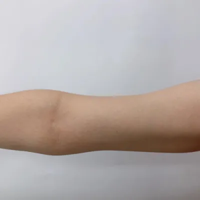 [Өөх соруулах] Халуун зуны зун - Гарын өөх задлах тариа