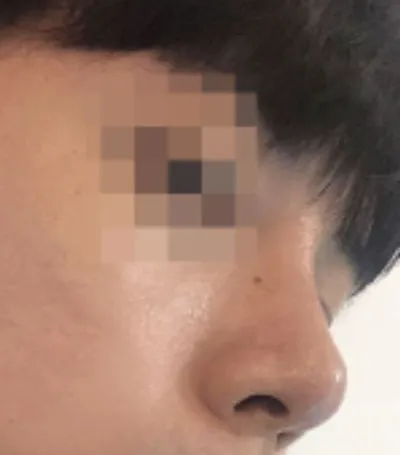 [Хамрын мэс засал] Koz 802 - Хамрын нуруу