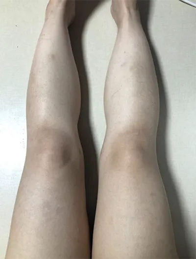 [Өөх соруулах] zz0808 - Өөх соруулах