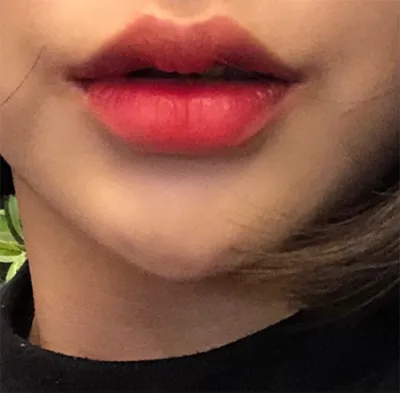 [Жижиг] ddd97 - Филлер, Ботокс