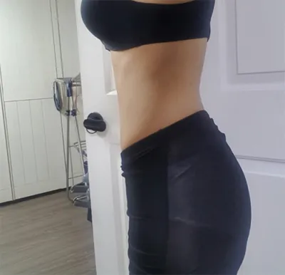 [Өөх соруулах] Juvederm - Өөх соруулах (хэвлий)