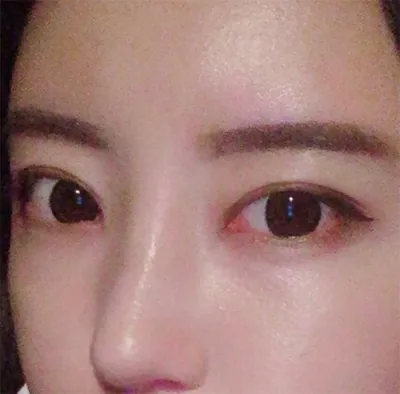 [Хамрын] tatun12 - Хамар, нүд, өөх шилжүүлэн суулгах